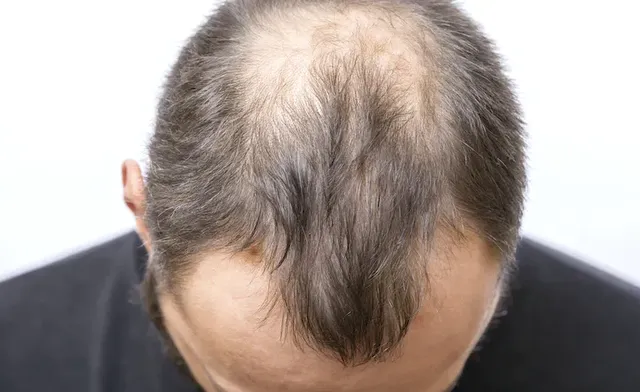 Post-Treatment: What Happens After Minoxidil Starts Showing Results